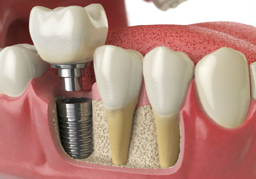 How to Tell if You Need Dental Implants in  Charleston SC